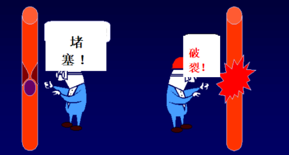 警惕“中风”突袭!脑卒中全面科普(图2) 警惕“中风”突袭!脑卒中全面科普(图2)